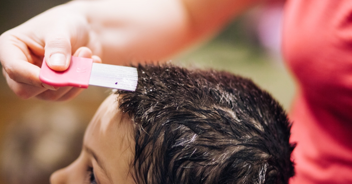 Common Lice Treatment Approved as OTC Padek Healthcare Pharmacy